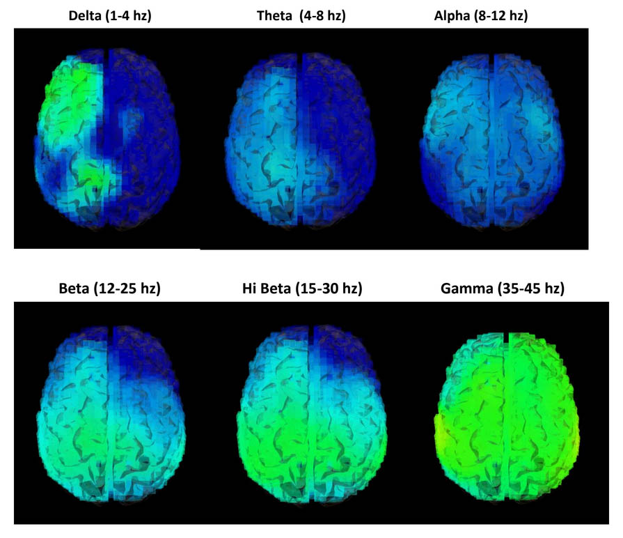 Soma breath meditation 3D brain images changes